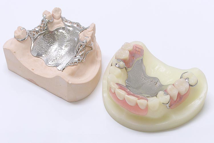 金属床義歯（自由診療の入れ歯）